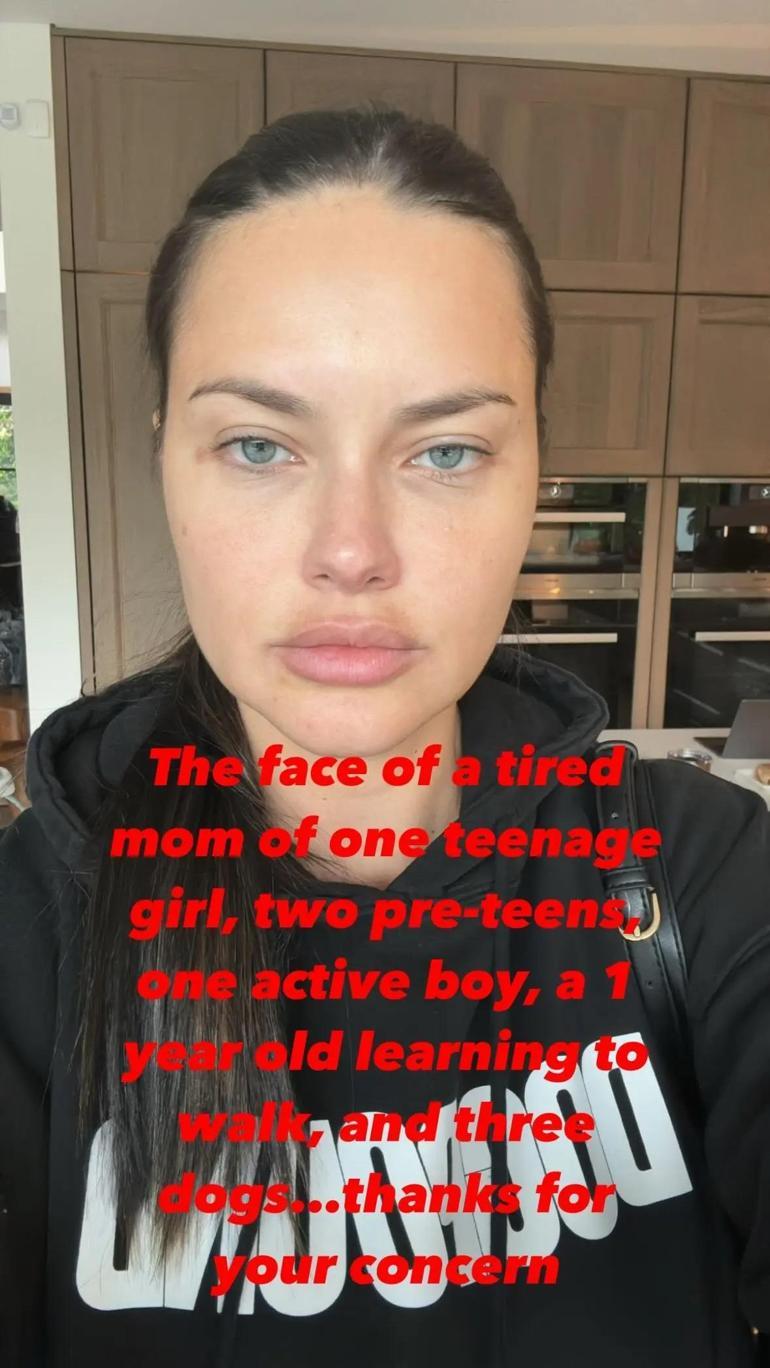 Adriana Lima'nın Estetik Tartışmaları ve Yeniden Doğuşu