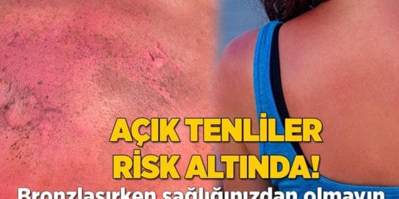 Açık tenliler risk altında! Bronzlaşırken sağlığınızdan olmayın