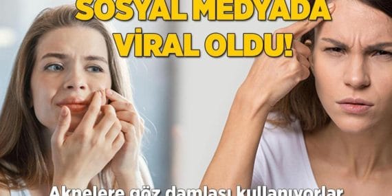 Sosyal Medyada Yeni Trend: Akneler İçin Göz Damlası Mucizesi mi?